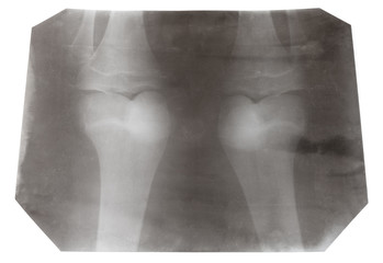 X-ray picture of two human knee-joints isolated
