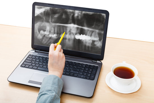 dentist analyzes X-ray picture of jaws on laptop