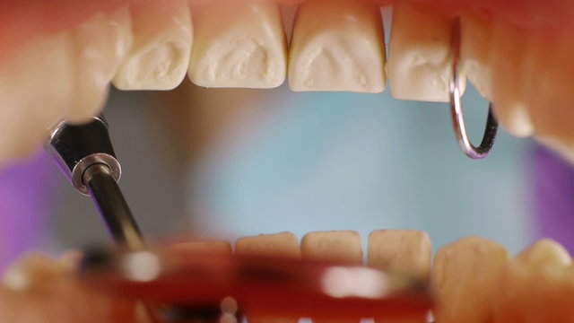 Teeth Inside Mouth Cleanup