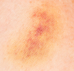 Fototapeta premium bruise on the skin