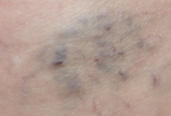 Fototapeta premium varicose veins in the leg