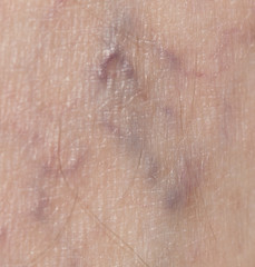 Fototapeta premium varicose veins in the leg
