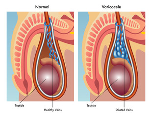 varicocele