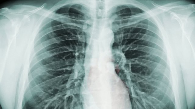 Chest x-ray and radiation. (loop ready file)