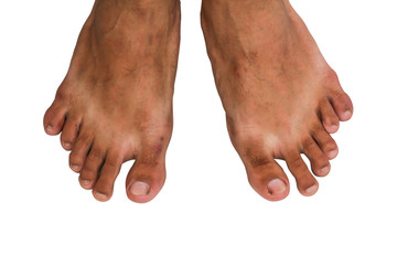 Foot with twelve toe, medical phenomenon