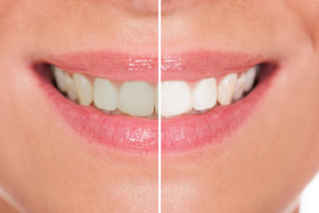 Close-up Of Woman Teeth