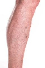 Varicose Veins on the legs of woman
