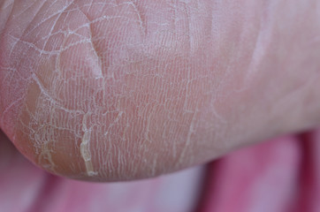 Fototapeta premium dry heel cracks