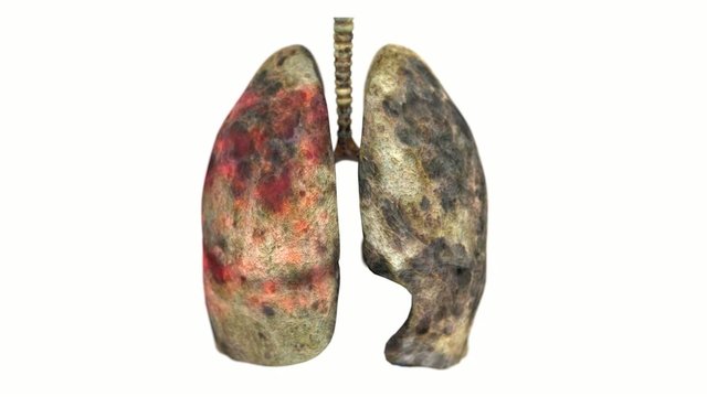 Tuberculosis in the lungs