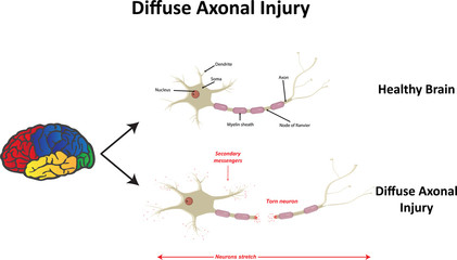 Diffuse Axonal Injury after Car Crash