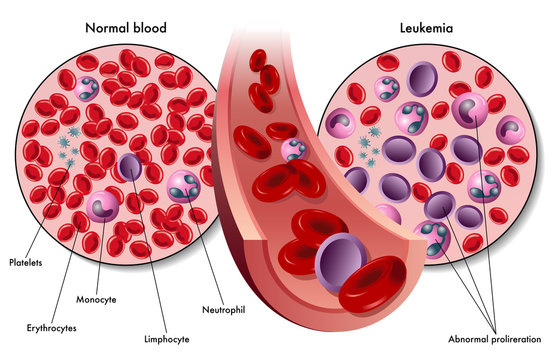leucemia