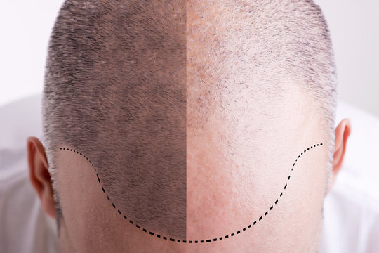 Hair Loss - Before and After