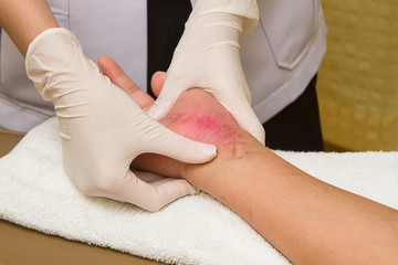 Obraz na płótnie Canvas Patient getting a therapy massage on scar