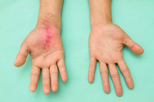 Scar Wound On Swollen And Inflamed Hand After Accident