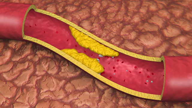 Artery With Clog Animation. Clogged artery shown with a cut out section displaying fat deposits and forming a clot. White Platelets in Bloodstream.