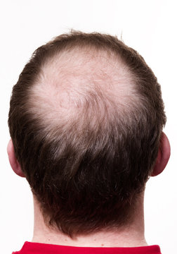 Kopf mit wenig Haaren