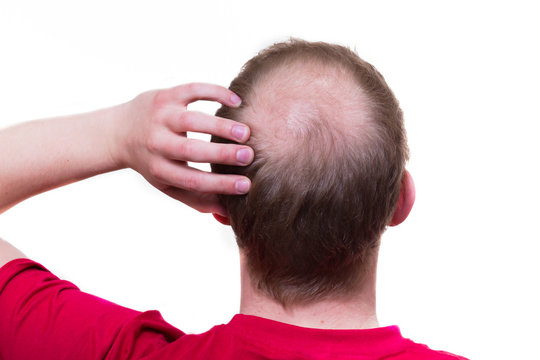 Mann mit kreisrunden Haarausfall