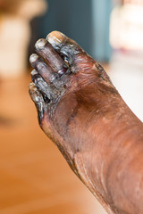 wound of diabetic foot