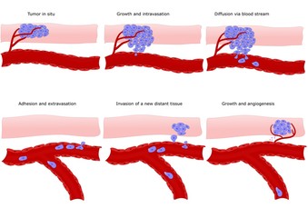 metastasi: formazione a distanza di un cancro - obrazy, fototapety, plakaty