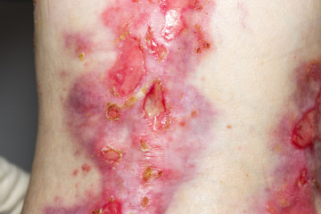 Epidermis bullosa