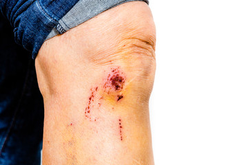 Schürfwunde am Bein