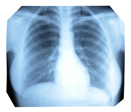 Photo X-ray of a healthy lung and heart