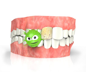 teeth with caries and bacteria