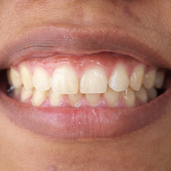 Diastema between the upper incisors is a normal feature
