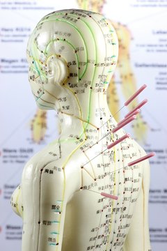 weibliches Akupunkturmodell mit Nadeln im Schulterbereich vor Lehrtafel