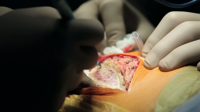 Surgical incision with electrosurgery