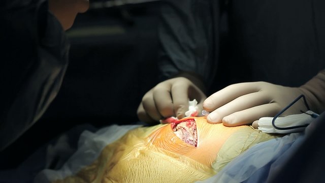 Surgery. Installation of pinion retractor into the wound.