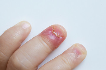 Fingernail bed inflammation, bacterial infection - 82241536