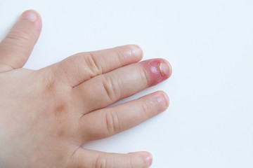 Fingernail bed inflammation, bacterial infection