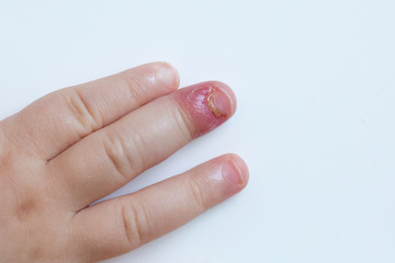 Fingernail bed inflammation, bacterial infection