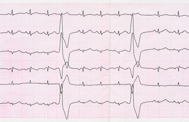 Tape ECG with ventricular premature beats (quadrigeminia)
