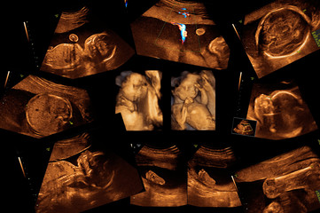 baby on the ultrasound image
