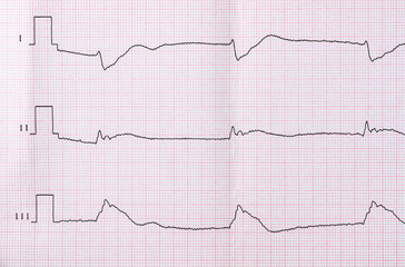 Tape ECG after clinical death and successful resuscitation