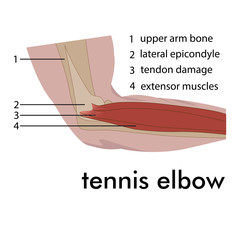 tennis elbow anatomy. vector illustration of injury