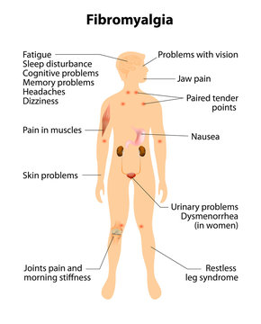 fibromyalgia. signs and symptoms.