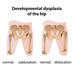 Dysplasia of the Hip