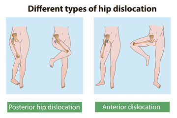 hip dislocation - obrazy, fototapety, plakaty