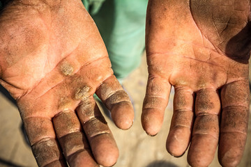 Injured open palms
