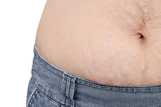 Closeup stretchmarks on Asian woman belly