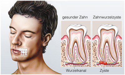 Gesunder Zahn und Zahnwurzelzyste