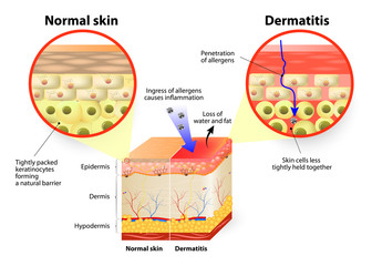 dermatitis or eczema - obrazy, fototapety, plakaty