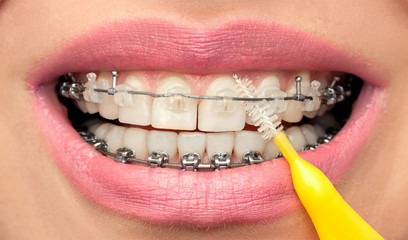 Dental Hygiene of Teeth with Braces with Interdental Brush.