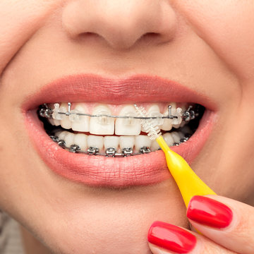 Dental Braces Hygiene. Orthodontic Treatment. Front view.