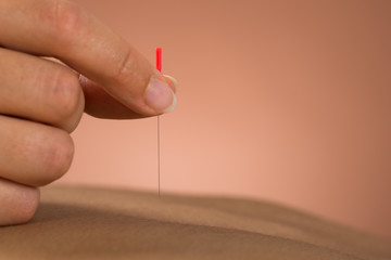 Therapist Giving Acupuncture Treatment