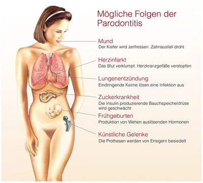 M&ouml;gliche Folgen der Parodontitis