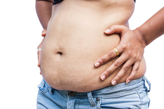 Women body with fat belly and stretch marks.
